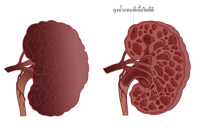โรคไต